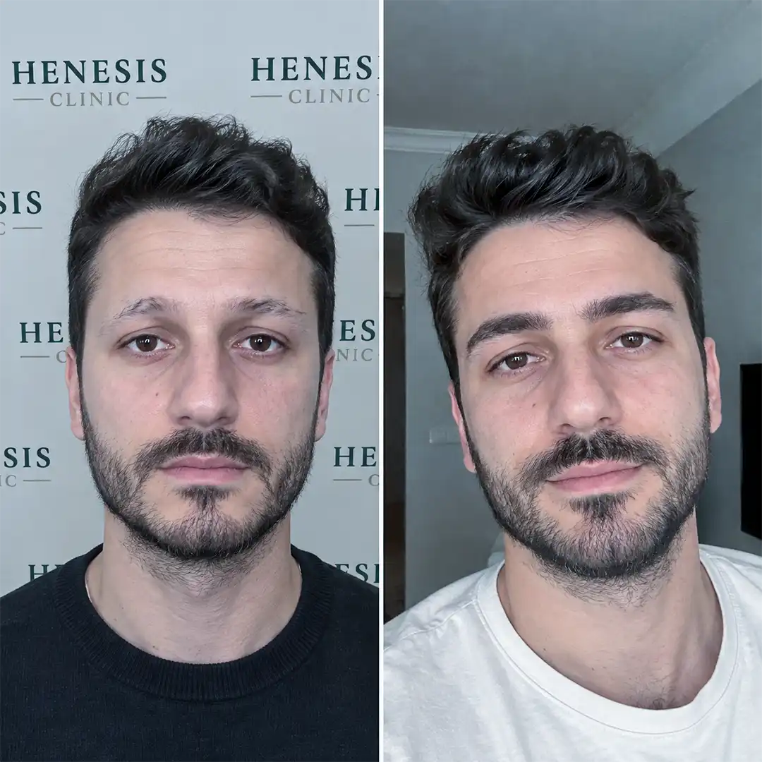 Before-treatment and 12-month follow-up photographs from documented case HNS-0064