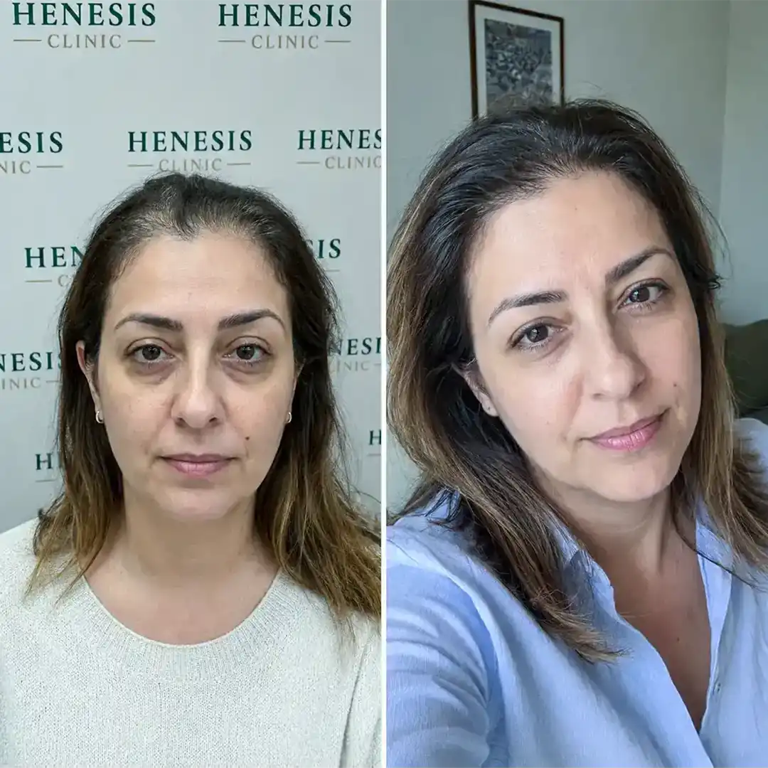 DHI hair transplant before and after result, 2,800 grafts at 12 months — case HNS-0065