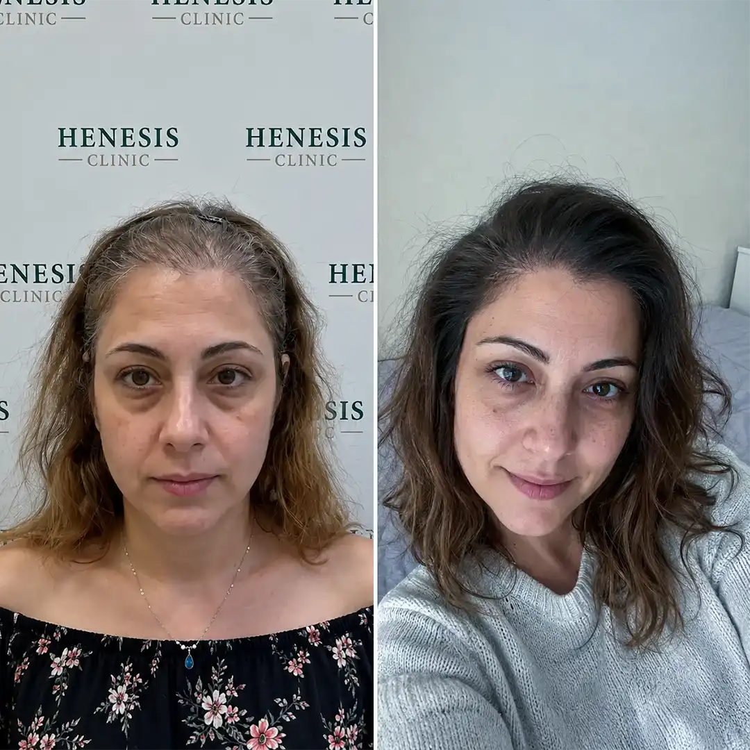 DHI hair transplant before and after result, 3,000 grafts at 12 months — case HNS-0066