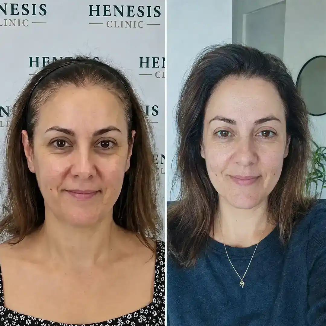 Female DHI hair transplant before treatment and 12-month follow-up — case HNS-0067
