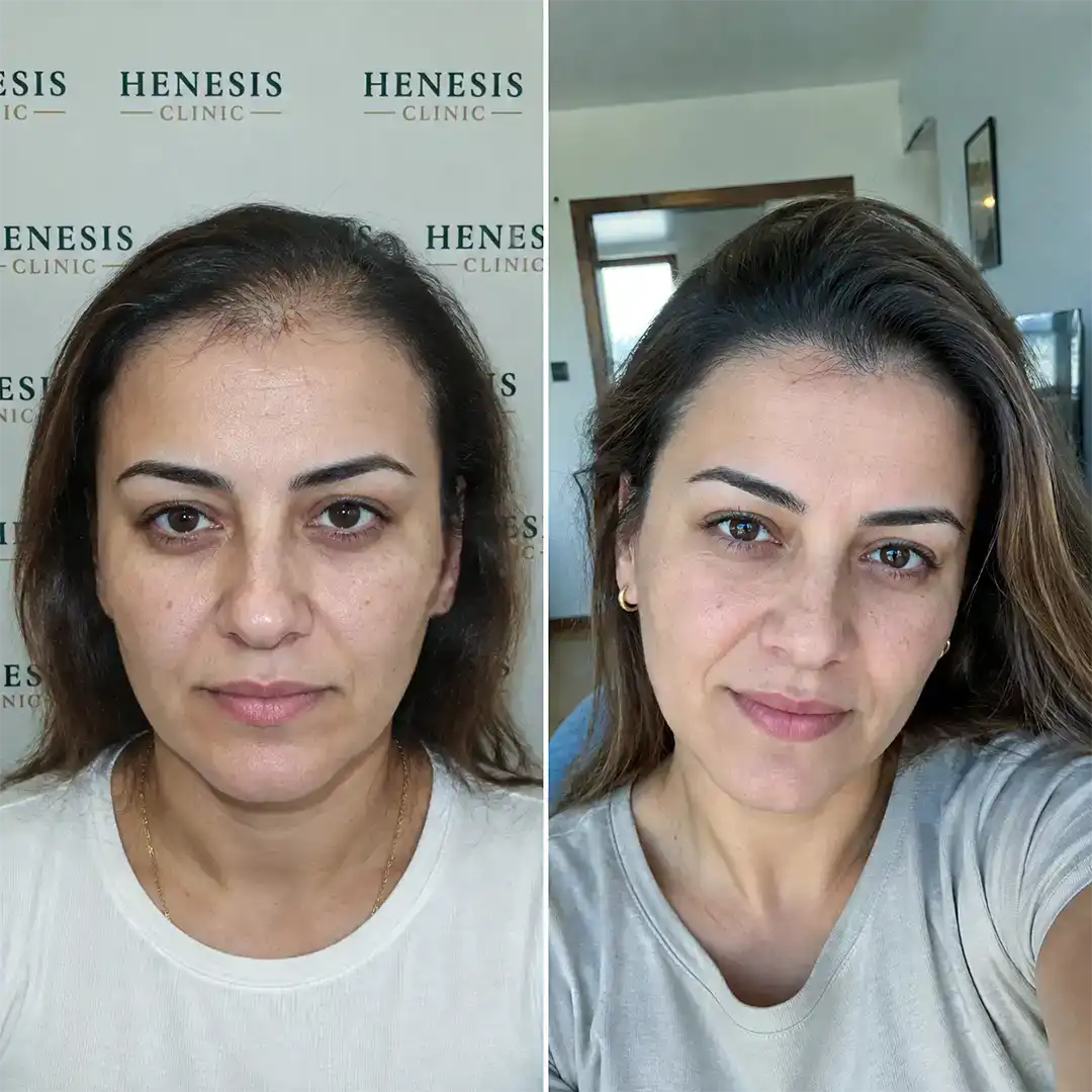 Female DHI hair transplant before treatment and 12-month follow-up — case HNS-0068