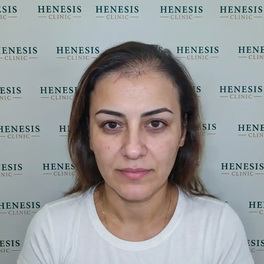 Procedure front view from documented case HNS-0068