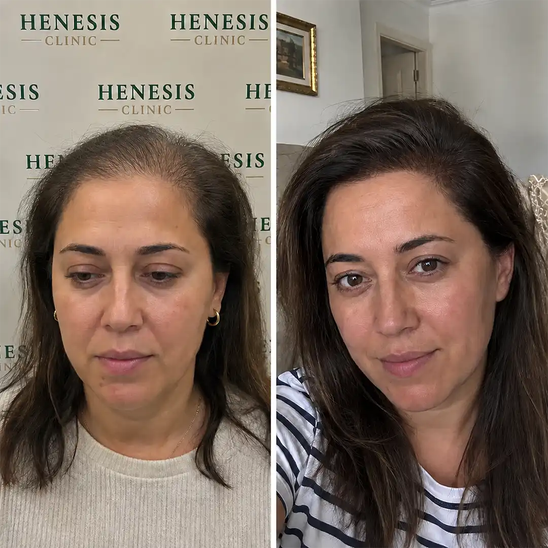 Before-treatment and 12-month follow-up photographs from documented case HNS-0069