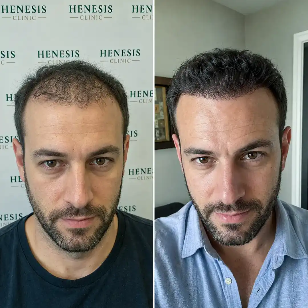 Before-treatment and 12-month follow-up photographs from documented case HNS-0070