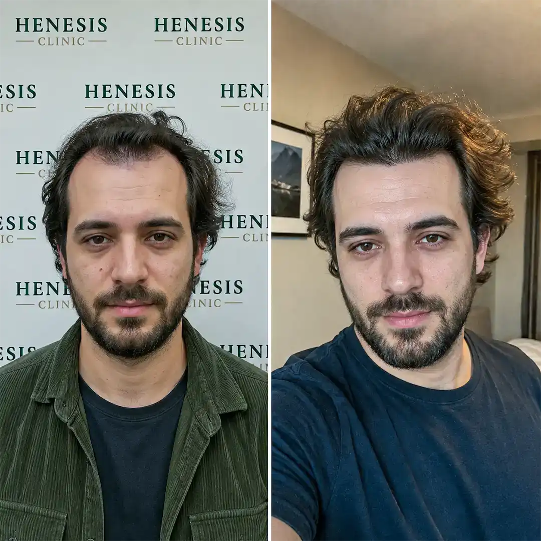 DHI hair transplant before and after result, 2,600 grafts at 12 months — case HNS-0072