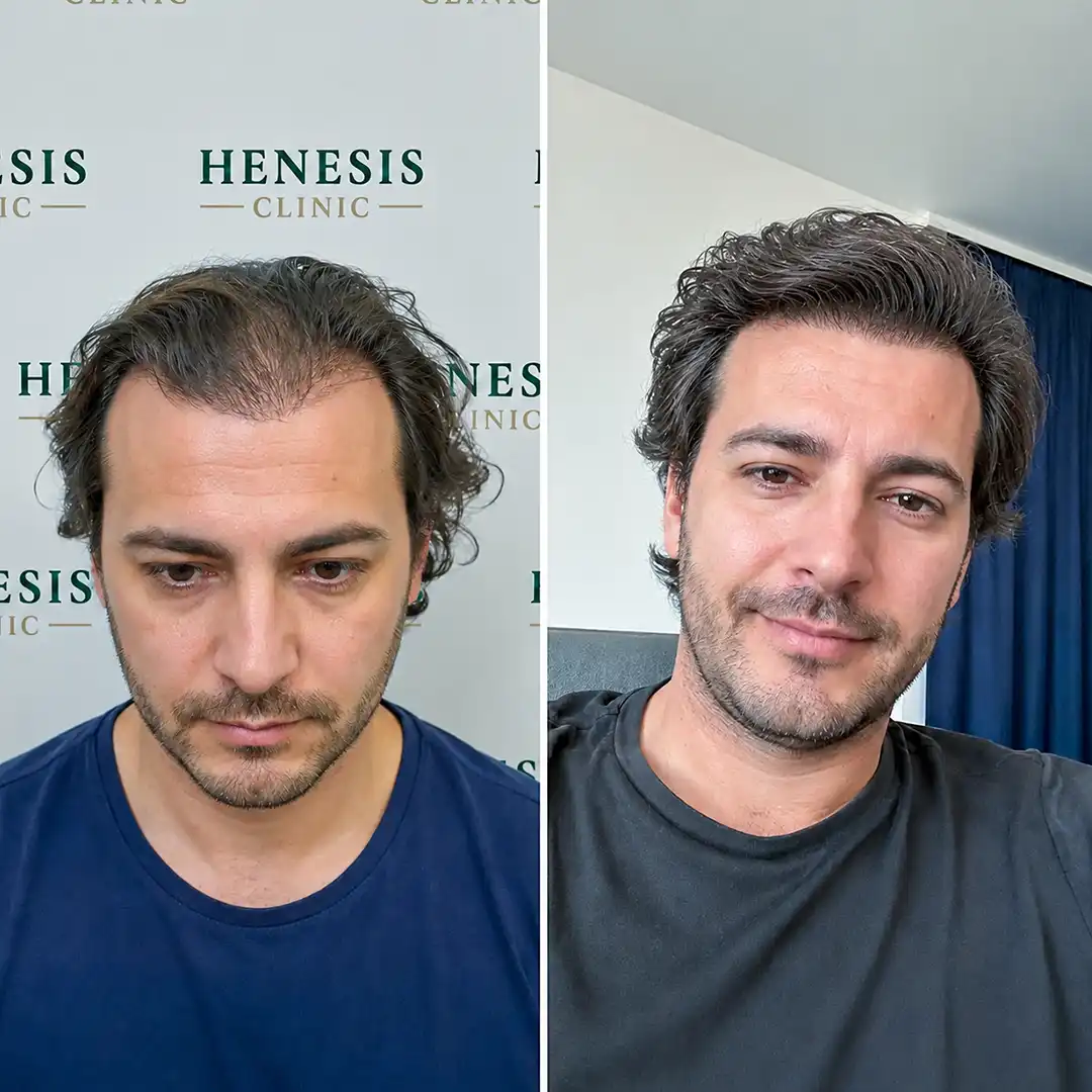 DHI hair transplant before and after result, 2,700 grafts at 12 months — case HNS-0073