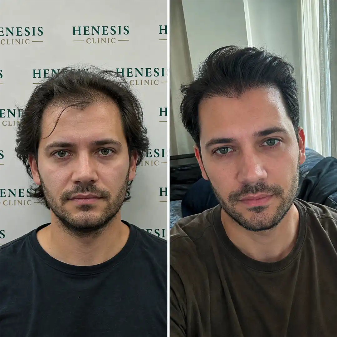 DHI hair transplant before and after result, 2,800 grafts at 12 months — case HNS-0074