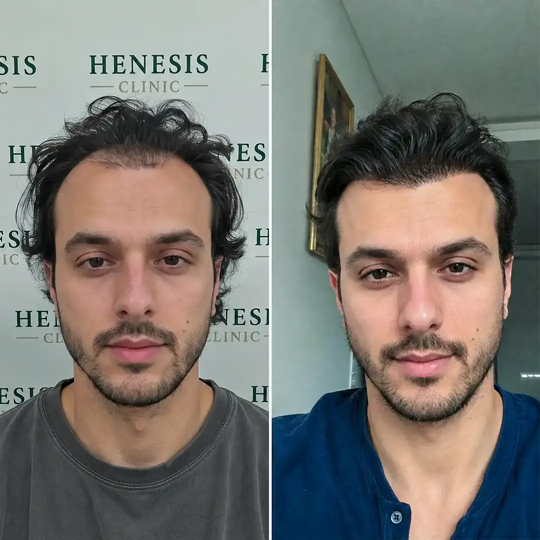 Before-treatment and 12-month follow-up photographs from documented case HNS-0075