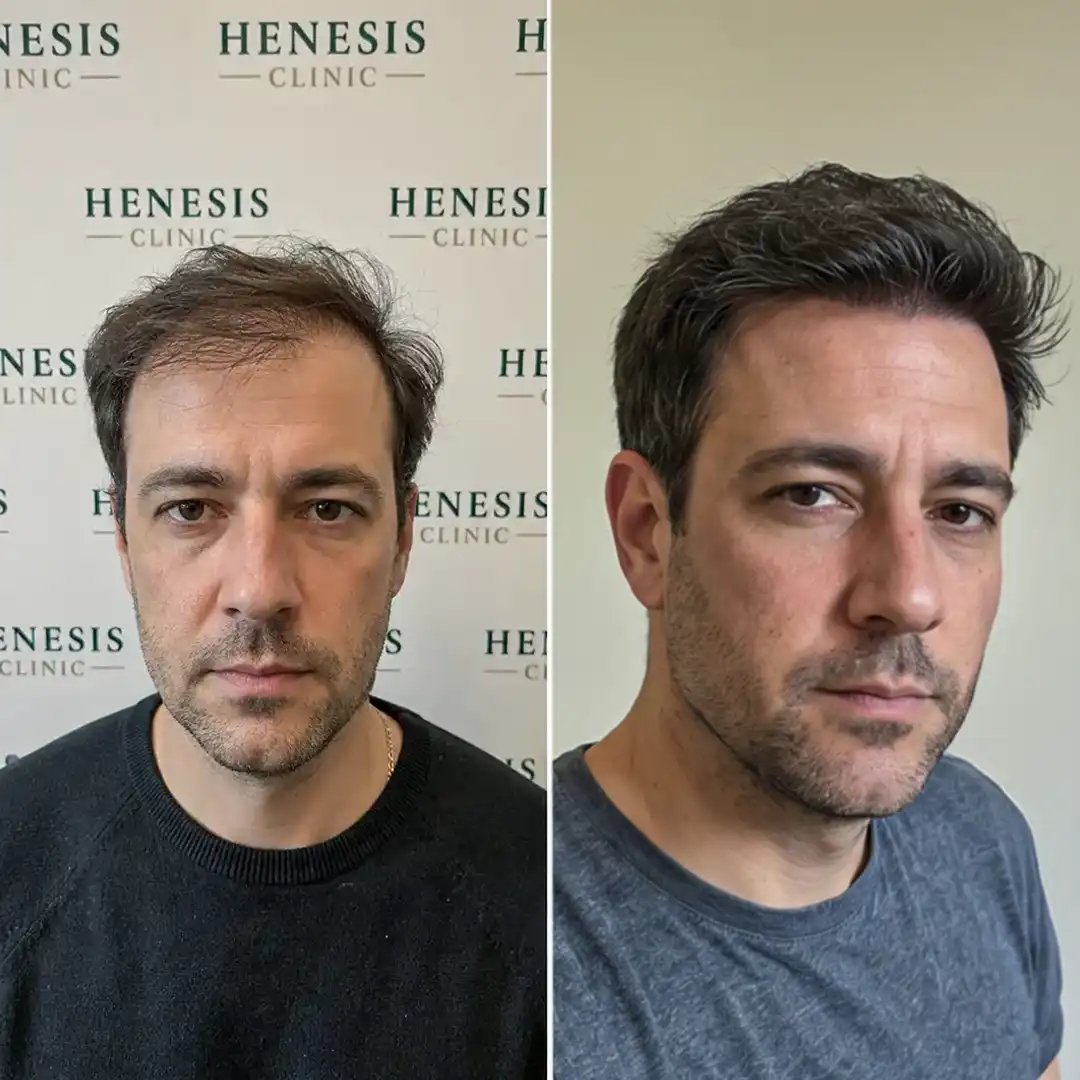 DHI hair transplant before and after result, 2,750 grafts at 12 months — case HNS-0076