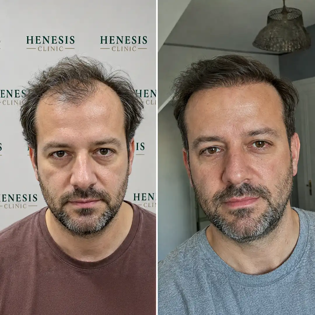 Before-treatment and 12-month follow-up photographs from documented case HNS-0077