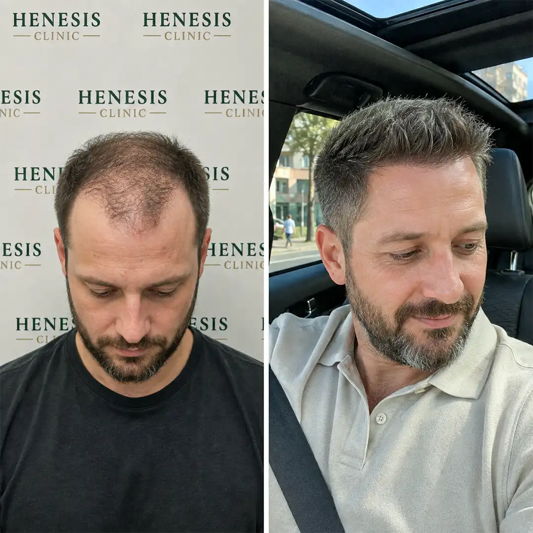 Sapphire FUE hair transplant before and after result, 3,800 grafts at 12 months — case HNS-0078