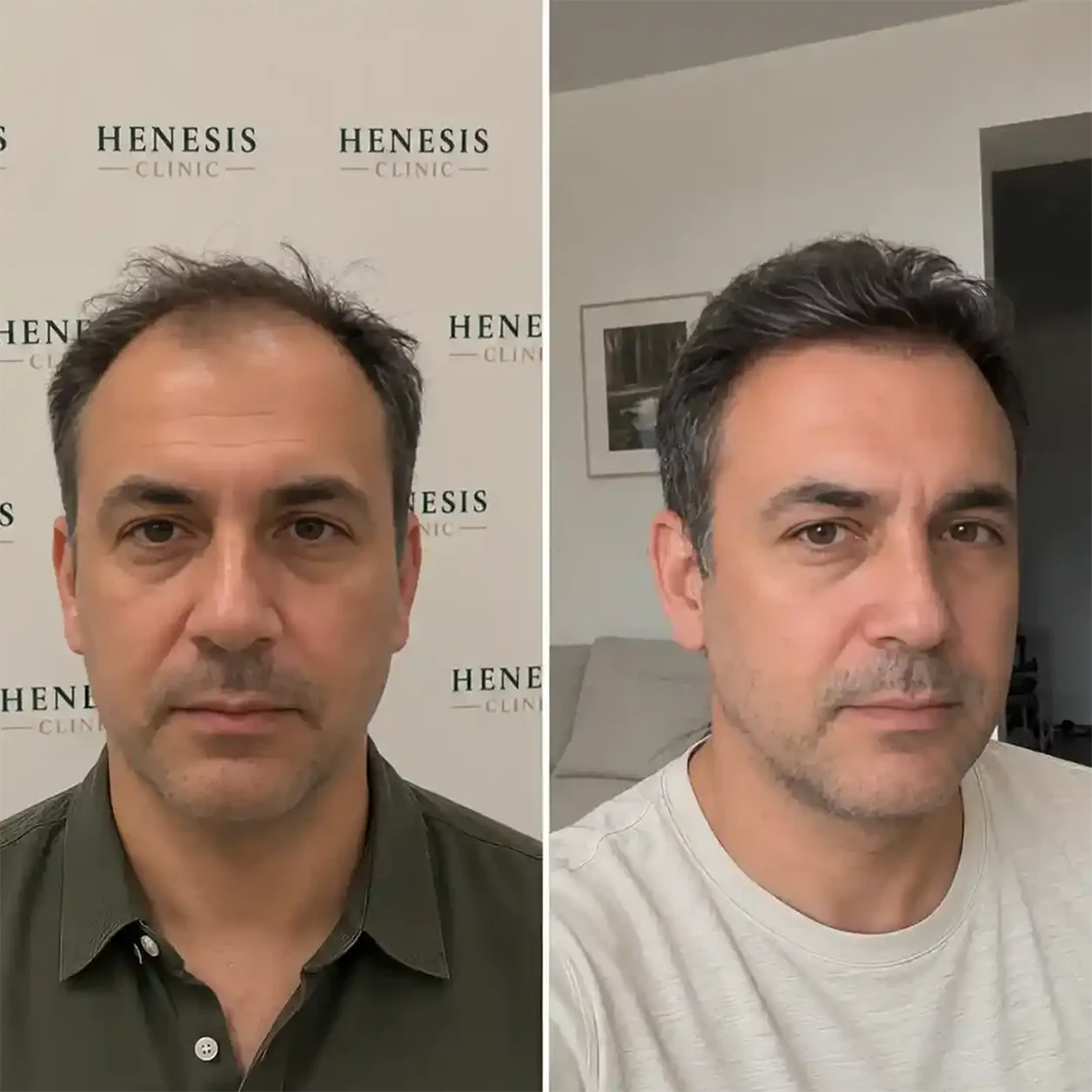 Sapphire FUE hair transplant before and after result, 4,000 grafts at 12 months — case HNS-0079