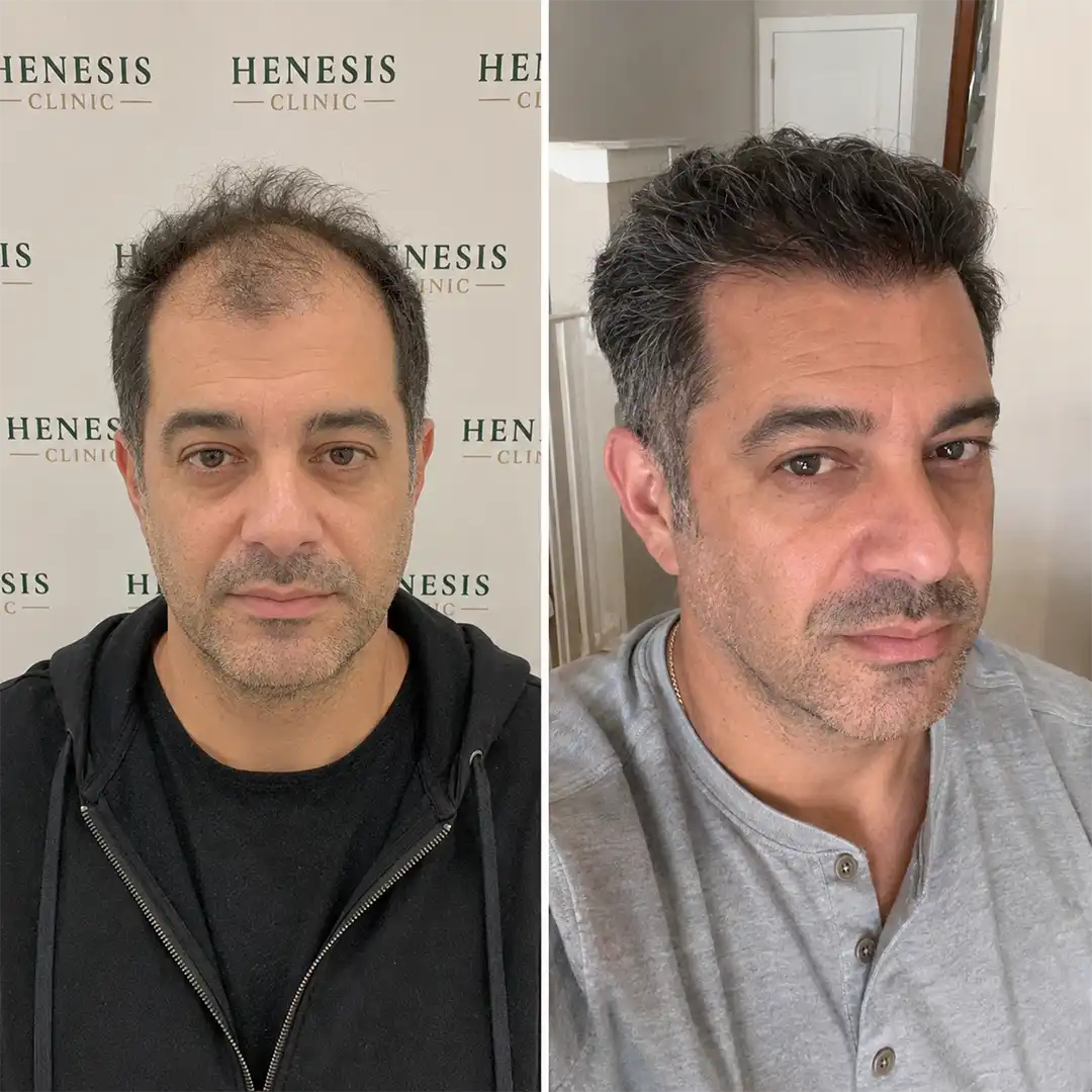 Sapphire FUE hair transplant before and after result, 3,600 grafts at 12 months — case HNS-0080
