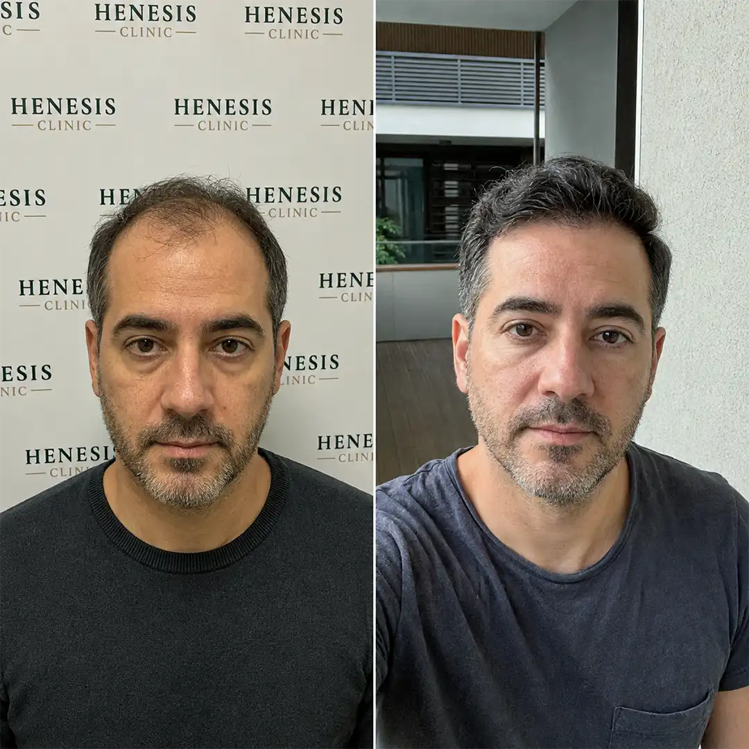 Sapphire FUE hair transplant before and after result, 3,500 grafts at 12 months — case HNS-0081