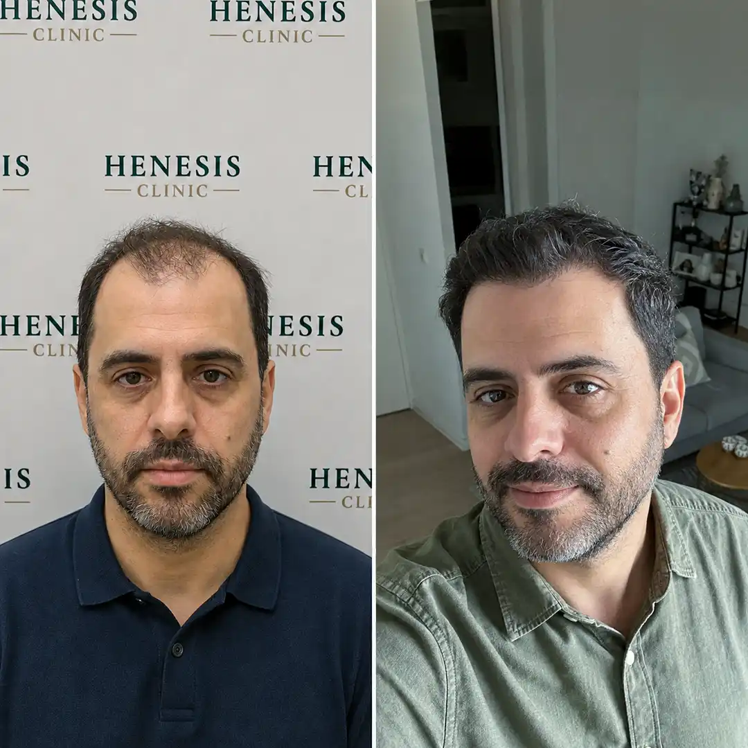 Sapphire FUE hair transplant before and after result, 3,700 grafts at 12 months — case HNS-0082