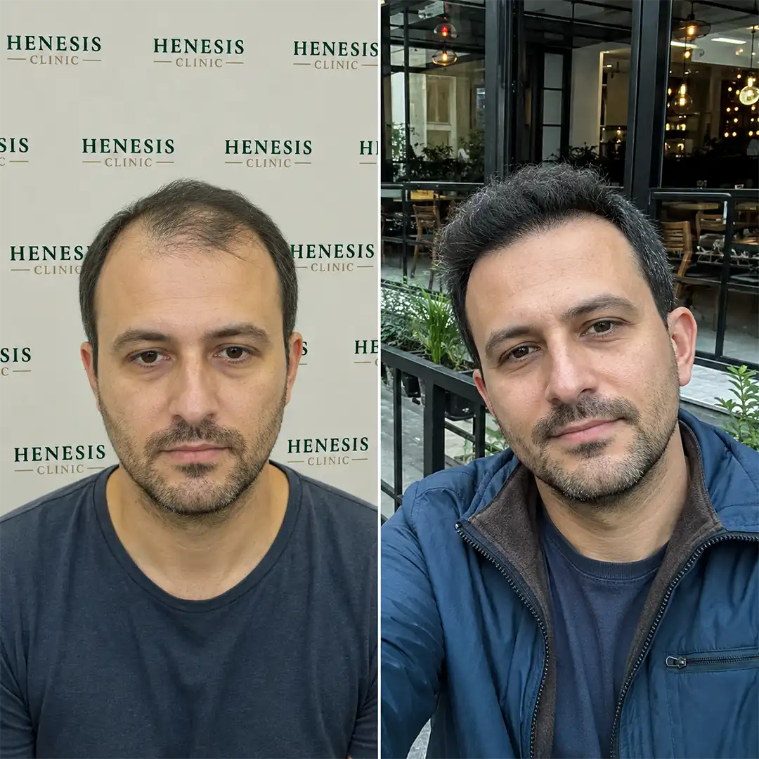 Sapphire FUE hair transplant before and after result, 4,650 grafts at 12 months — case HNS-0084