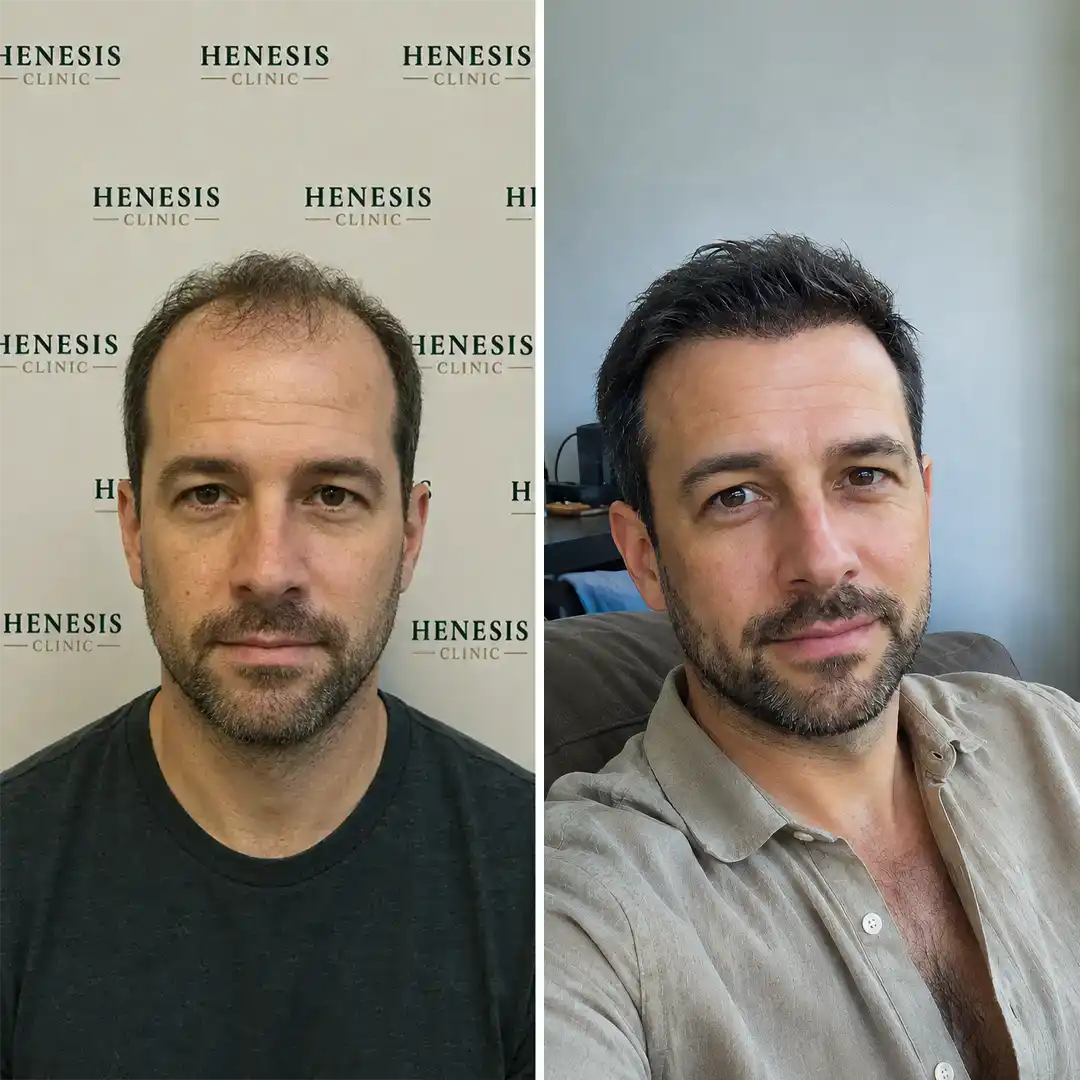 Sapphire FUE hair transplant before and after result, 4,300 grafts at 12 months — case HNS-0085