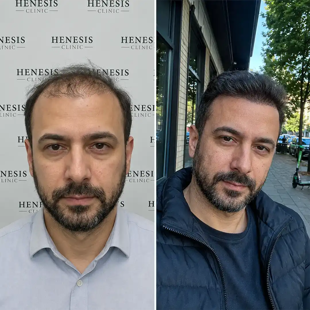 Before-treatment and 12-month follow-up photographs from documented case HNS-0086