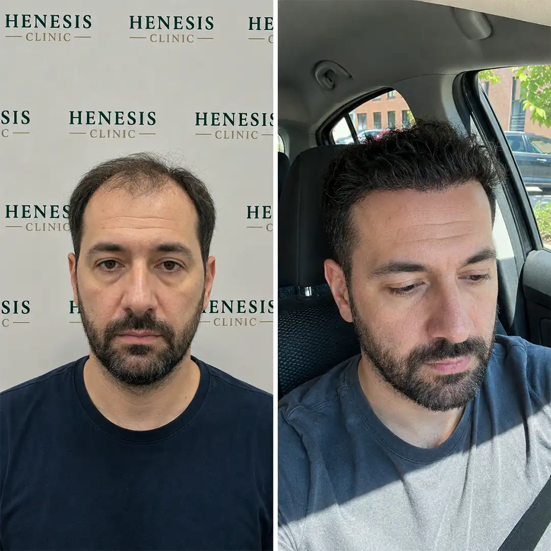 Before-treatment and 12-month follow-up photographs from documented case HNS-0087