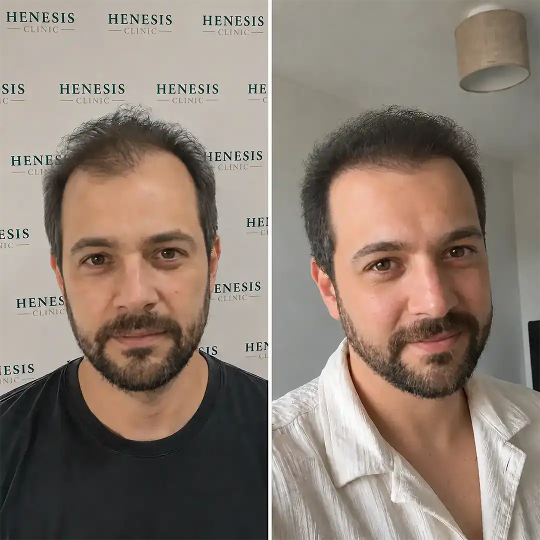 Before-treatment and 12-month follow-up photographs from documented case HNS-0088