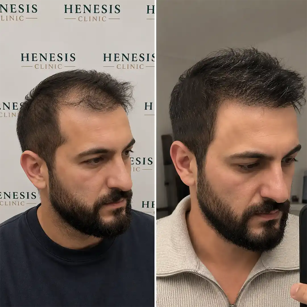 Before-treatment and 12-month follow-up photographs from documented case HNS-0089
