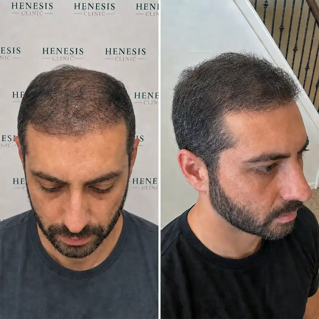 Before-treatment and 12-month follow-up photographs from documented case HNS-0090
